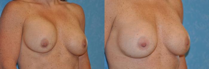 Before & After Implant Revision Case 207 View #2 View in Toledo, Ohio