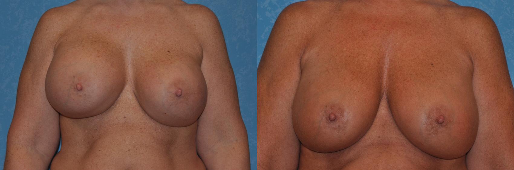 Before & After Implant Revision Case 273 View #1 View in Toledo, Ohio