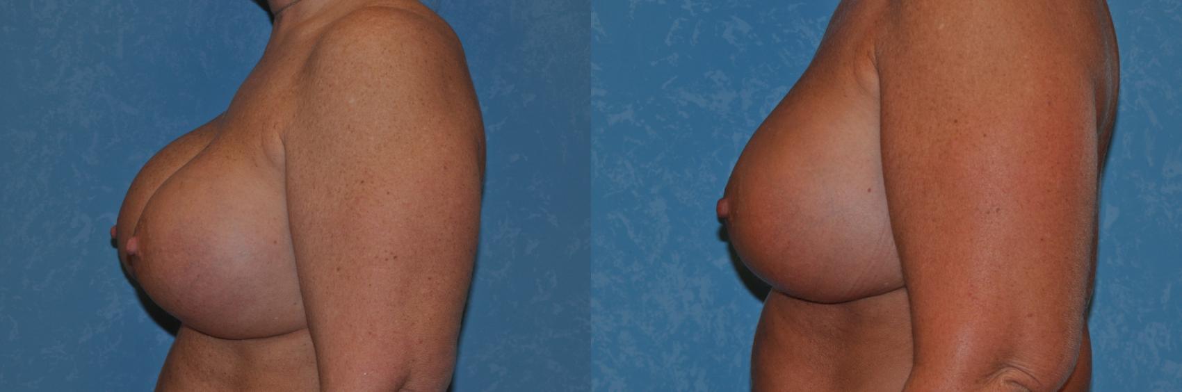 Before & After Implant Revision Case 273 View #2 View in Toledo, Ohio