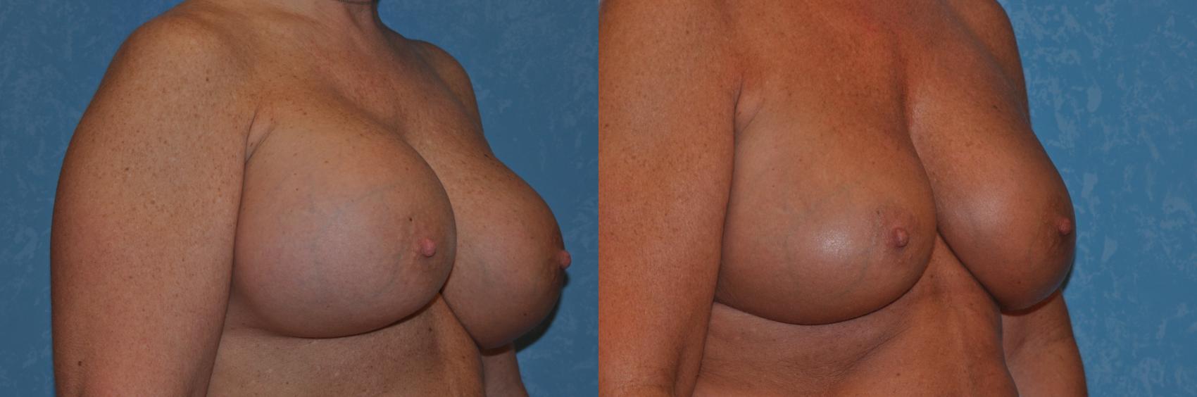 Before & After Implant Revision Case 273 View #3 View in Toledo, Ohio