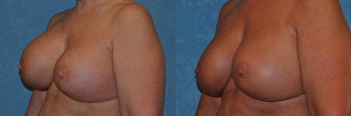 Before & After Implant Revision Case 273 View #4 View in Toledo, Ohio