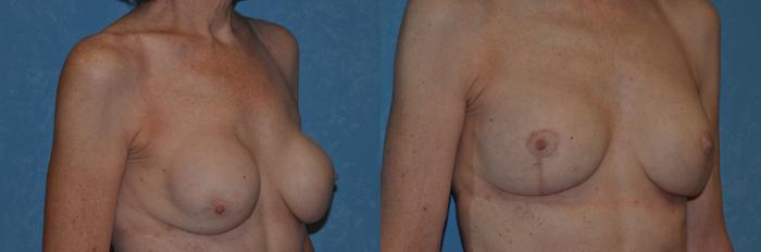 Before & After Implant Revision Case 274 View #2 View in Toledo, Ohio