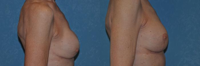 Before & After Implant Revision Case 274 View #4 View in Toledo, Ohio
