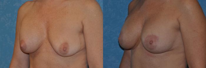 Before & After Implant Revision Case 328 View #3 View in Toledo, Ohio