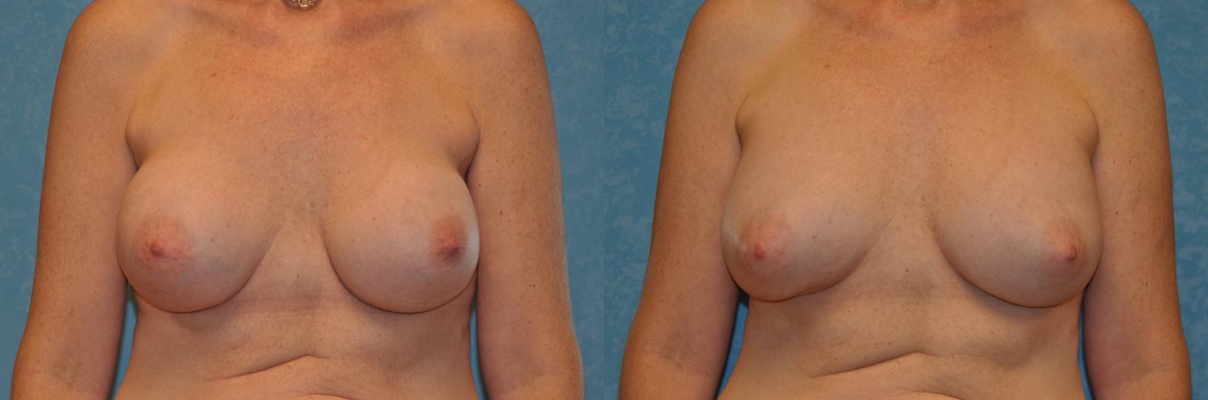 Before & After Breast Augmentation Case 394 Front View in Toledo, Ohio