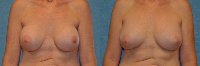 Before & After Breast Augmentation Case 394 Front View in Toledo, Ohio