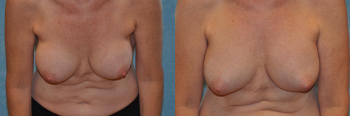 Before & After Breast Augmentation Case 394 Leaning Forward View in Toledo, Ohio