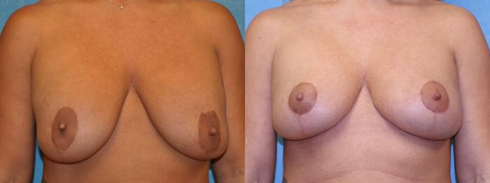 Before & After Breast Lift With Implants Case 439 Front View in Toledo, Ohio