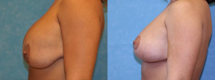 Before & After Implant Revision Case 439 Left Side View in Toledo, Ohio