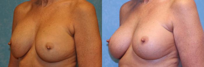 Before & After Implant Revision Case 441 Left Oblique View in Toledo, Ohio