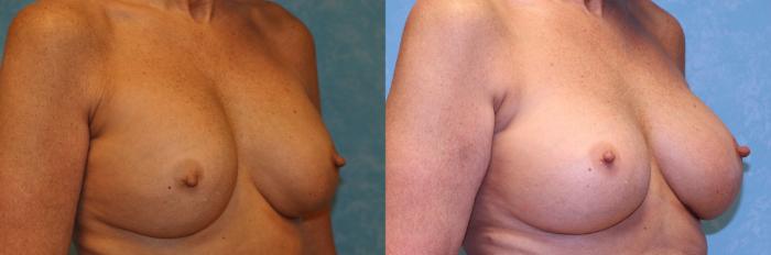 Before & After Implant Revision Case 441 Right Oblique View in Toledo, Ohio