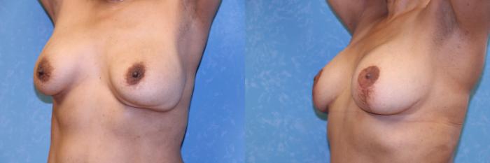 Before & After Implant Revision Case 472 Left Oblique View in Toledo, Ohio