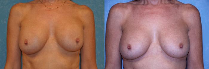Before & After Breast Augmentation Case 495 Front View in Toledo, Ohio