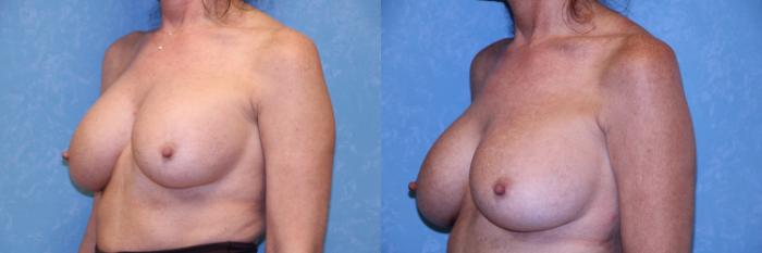 Before & After Breast Augmentation Case 495 Left Oblique View in Toledo, Ohio
