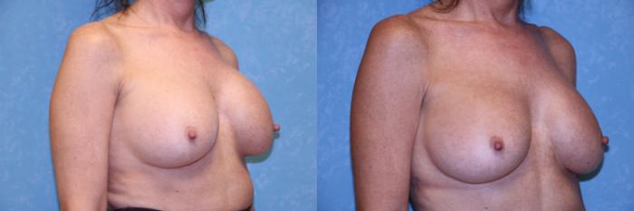 Before & After Breast Augmentation Case 495 Right Oblique View in Toledo, Ohio