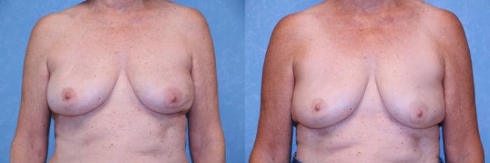 Before & After Implant Revision Case 512 2 Weeks Post Op vs. 6 Months Post Op View in Toledo, Ohio