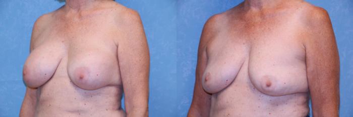 Before & After Implant Revision Case 512 Left Oblique View in Toledo, Ohio