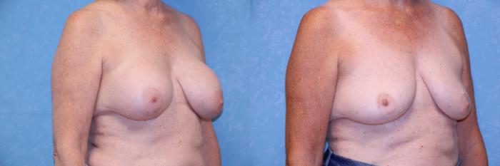 Before & After Implant Revision Case 512 Right Oblique View in Toledo, Ohio