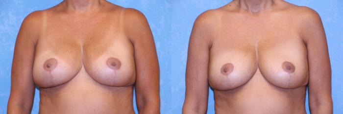 Before & After Implant Revision Case 514 10 Months Post Op View in Toledo, Ohio