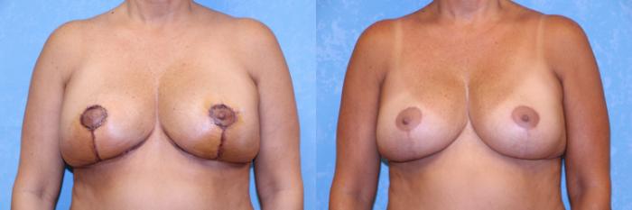 Before & After Implant Revision Case 514 3 Months Post Op View in Toledo, Ohio