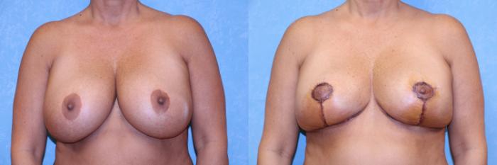 Before & After Breast Reduction Case 514 Front View in Toledo, Ohio