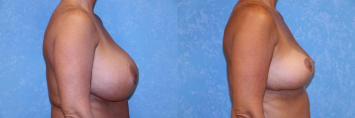 Before & After Breast Reduction Case 514 Right Side View in Toledo, Ohio
