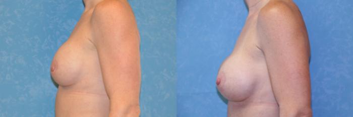 Before & After Implant Revision Case 515 Left Side View in Toledo, Ohio
