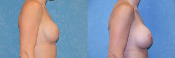 Before & After Implant Revision Case 515 Right Side View in Toledo, Ohio