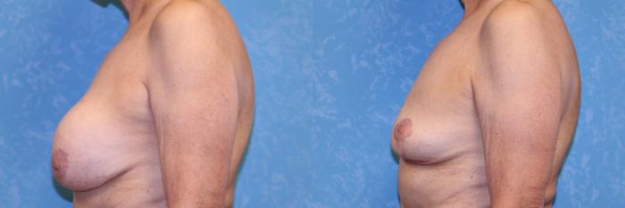 Before & After Implant Revision Case 519 Left Side View in Toledo, Ohio