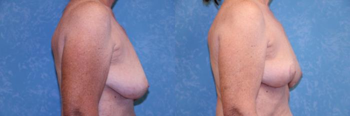 Before & After Implant Revision Case 529 Right Side View in Toledo, Ohio