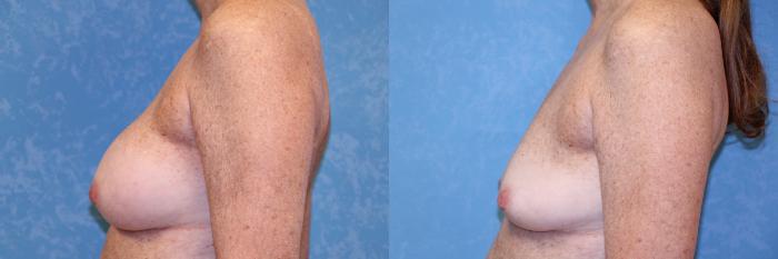 Before & After Implant Revision Case 535 Left Side View in Toledo, Ohio