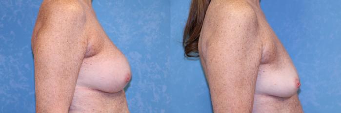 Before & After Implant Revision Case 535 Right Side View in Toledo, Ohio