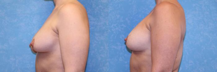 Before & After Implant Revision Case 545 Left Side View in Toledo, Ohio