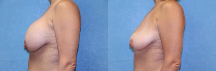 Before & After Implant Revision Case 546 Left Side View in Toledo, Ohio