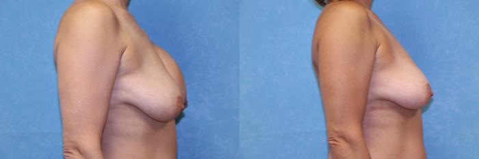 Before & After Implant Revision Case 546 Right Side View in Toledo, Ohio