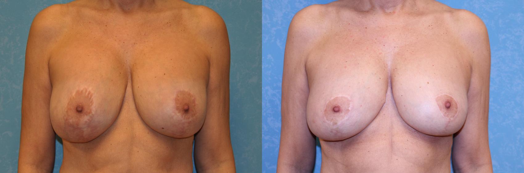 Before & After Complex Cases Case 550 Front View in Toledo, Ohio
