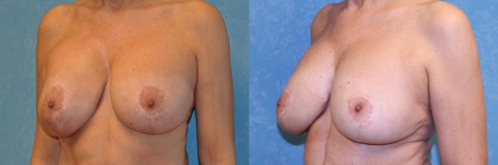 Before & After Complex Cases Case 550 Left Oblique View in Toledo, Ohio