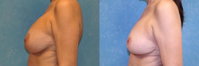 Before & After Complex Cases Case 550 Left Side View in Toledo, Ohio