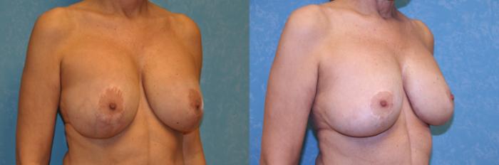 Before & After Complex Cases Case 550 Right Oblique View in Toledo, Ohio