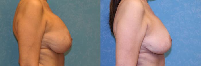 Before & After Complex Cases Case 550 Right Side View in Toledo, Ohio