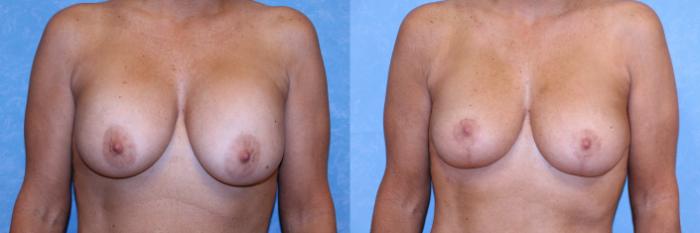 Before & After Implant Revision Case 594 Front View in Toledo, Ohio