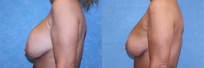 Before & After Implant Revision Case 594 Left Side View in Toledo, Ohio