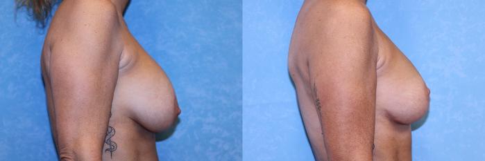Before & After Implant Revision Case 594 Right Side View in Toledo, Ohio