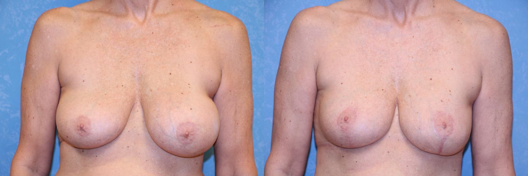 Before & After Implant Revision Case 595 Front View in Toledo, Ohio
