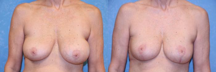 Before & After Implant Revision Case 595 Front View in Toledo, Ohio