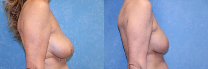 Before & After Implant Revision Case 595 Right Side View in Toledo, Ohio