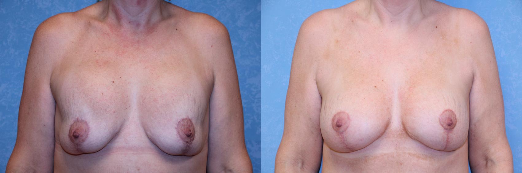Before & After Implant Revision Case 599 Front View in Toledo, Ohio