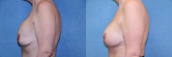 Before & After Implant Revision Case 599 Left Side View in Toledo, Ohio
