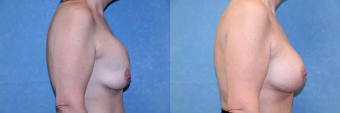 Before & After Implant Revision Case 599 Right Side View in Toledo, Ohio
