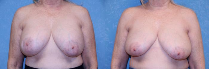 Before & After Implant Revision Case 603 Front View in Toledo, Ohio